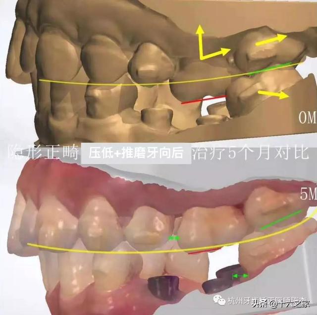 正畸临床病例(六)—简单高效推磨牙向后技巧