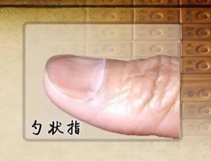 但若是有 缺铁性贫血的人指甲则会呈现出 中部凹陷,边缘