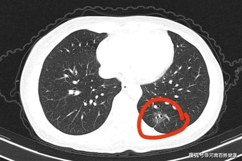 刘女士ct影像图中,肺癌病灶像瞪着两只"坏眼睛"