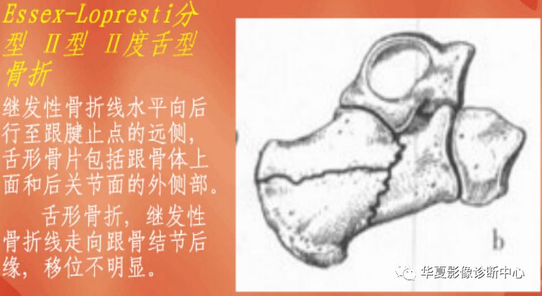 根据骨折移位程度又可将这两种类型的关节内骨折分为Ⅰ-Ⅲ度