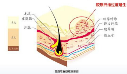 淤青怎么快速消除（淤青怎么快速消除热敷还是冷敷）