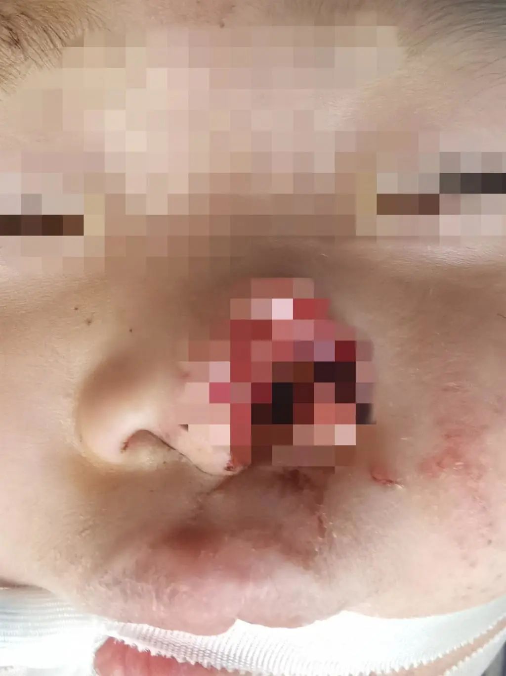 儿子的左边鼻子被硬生生咬了下来,只剩下一个血淋淋的黑洞