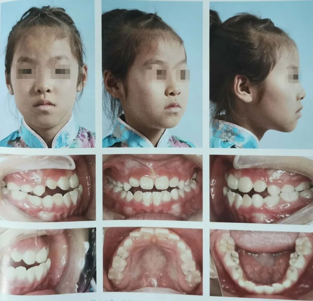 掌握黄金时期关注儿童牙齿早期矫正