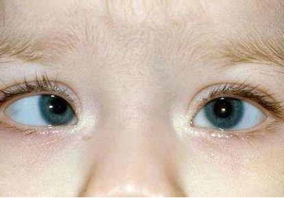 小孩眼睛出现斜视怎样矫正?斜视的种类有哪些?