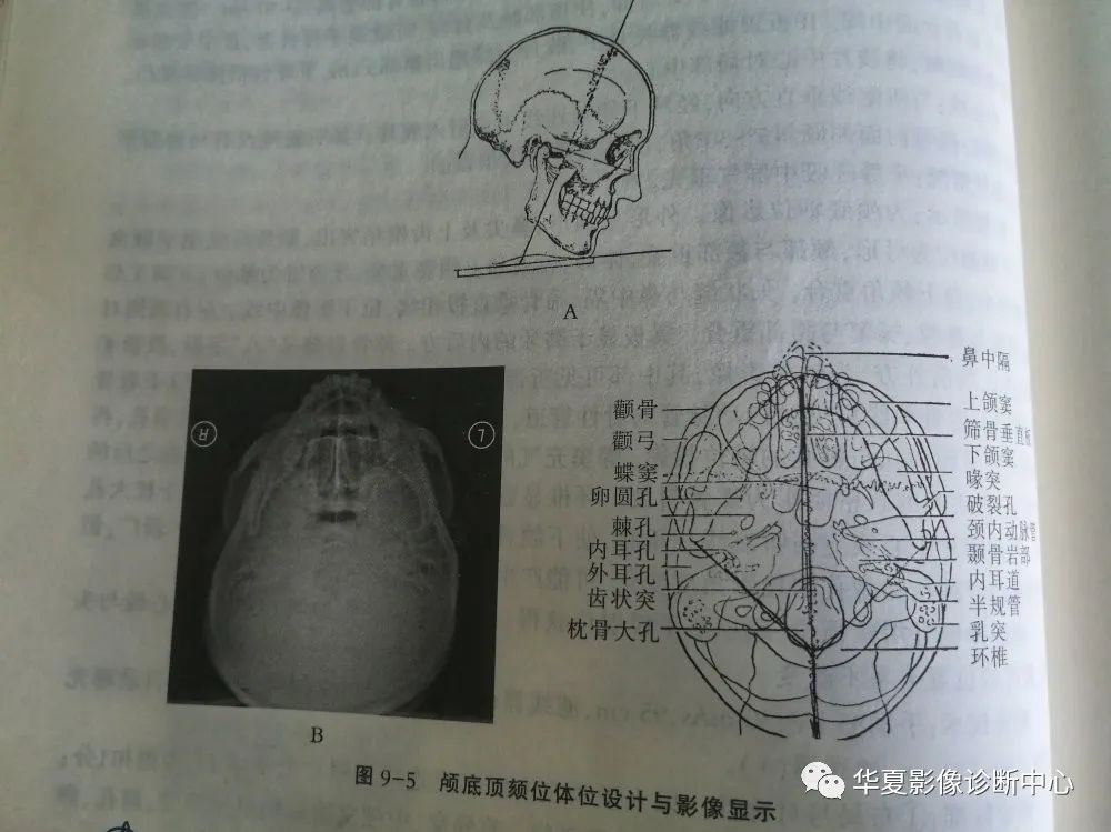 (头颅特殊部位)