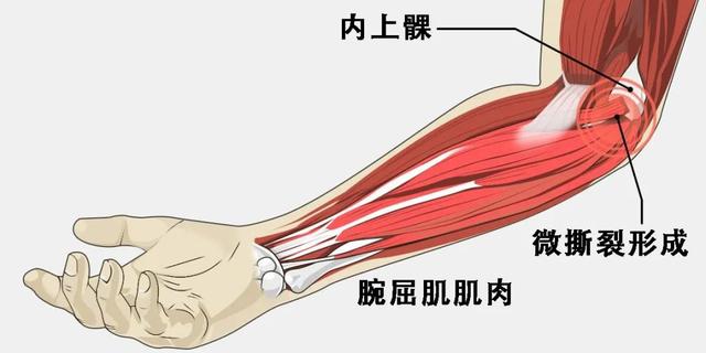 肘腱炎也称为上髁炎,通常是指由于肌肉和肌腱进行了重复动作而变得