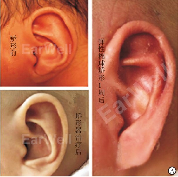 耳甲反弓形成"s"形软骨嵴,外耳道口狭窄; d.