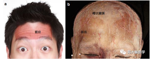 额肌起自冠状缝附近的帽状腱膜,收缩时可形成额纹.