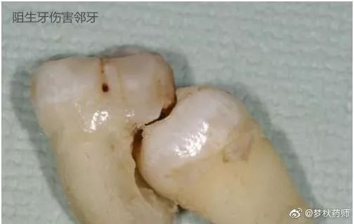 「智齿」吃嘛嘛都香生个孩子掉颗牙？孕妈妈经验分享：备孕先看牙