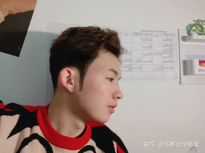 【术后一周,远拍效果【术后第2天,已经开始变自然】男士的鬓角上承