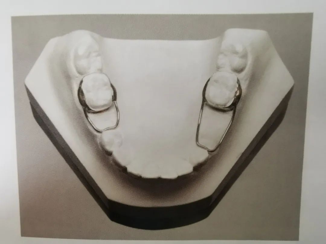 间隙保持器可以很好地保持缺牙间隙,待继承恒牙正常萌出