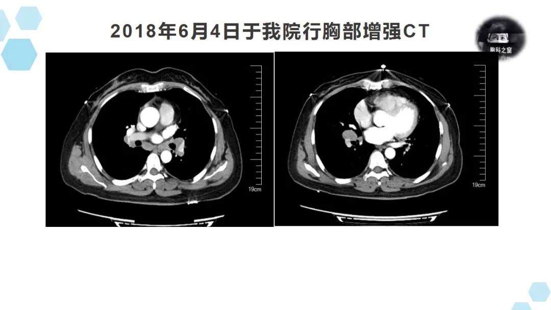 胸部增强ct检查所见右肺门可见不规则软组织密度肿块影，增强扫描可见强