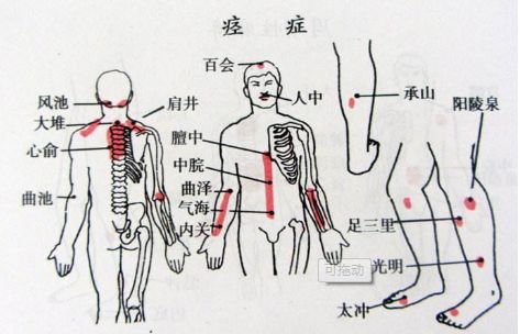 痉挛性斜颈的治疗原理_有病早治花的是小钱,有病拖着不治害的是身体,拖得严重了再治花的是