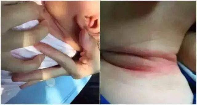 『爽身粉』孩子淹脖子怎么办？奶奶竟用爽身粉！这种错误别再犯了