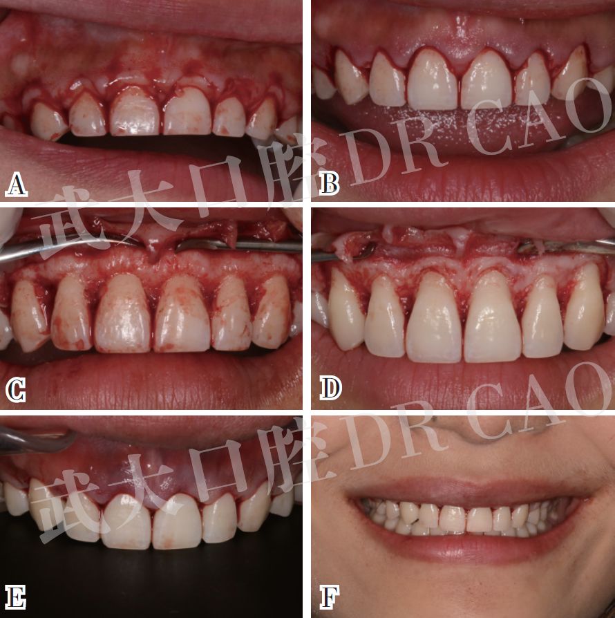 病例1定点,切龈,翻瓣,去除一定量牙槽骨,缝合