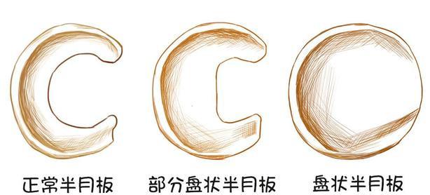 这类半月板问题偏爱亚洲人,而且可能有遗传性——盘状