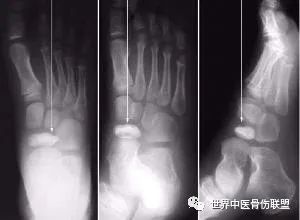 有人无选择的拍摄了100张足部x线片,有37%的舟骨由多个骨化中心发育