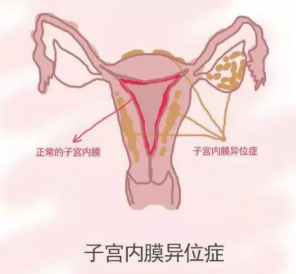 正常情况下女性的子宫内膜,是覆盖在子宫体腔的表面,如果它不在子宫的