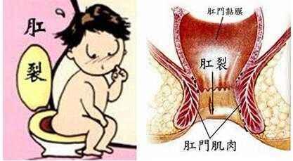 30岁男性排便疼痛伴便血不是痔疮也不是肛裂而是癌症晚期