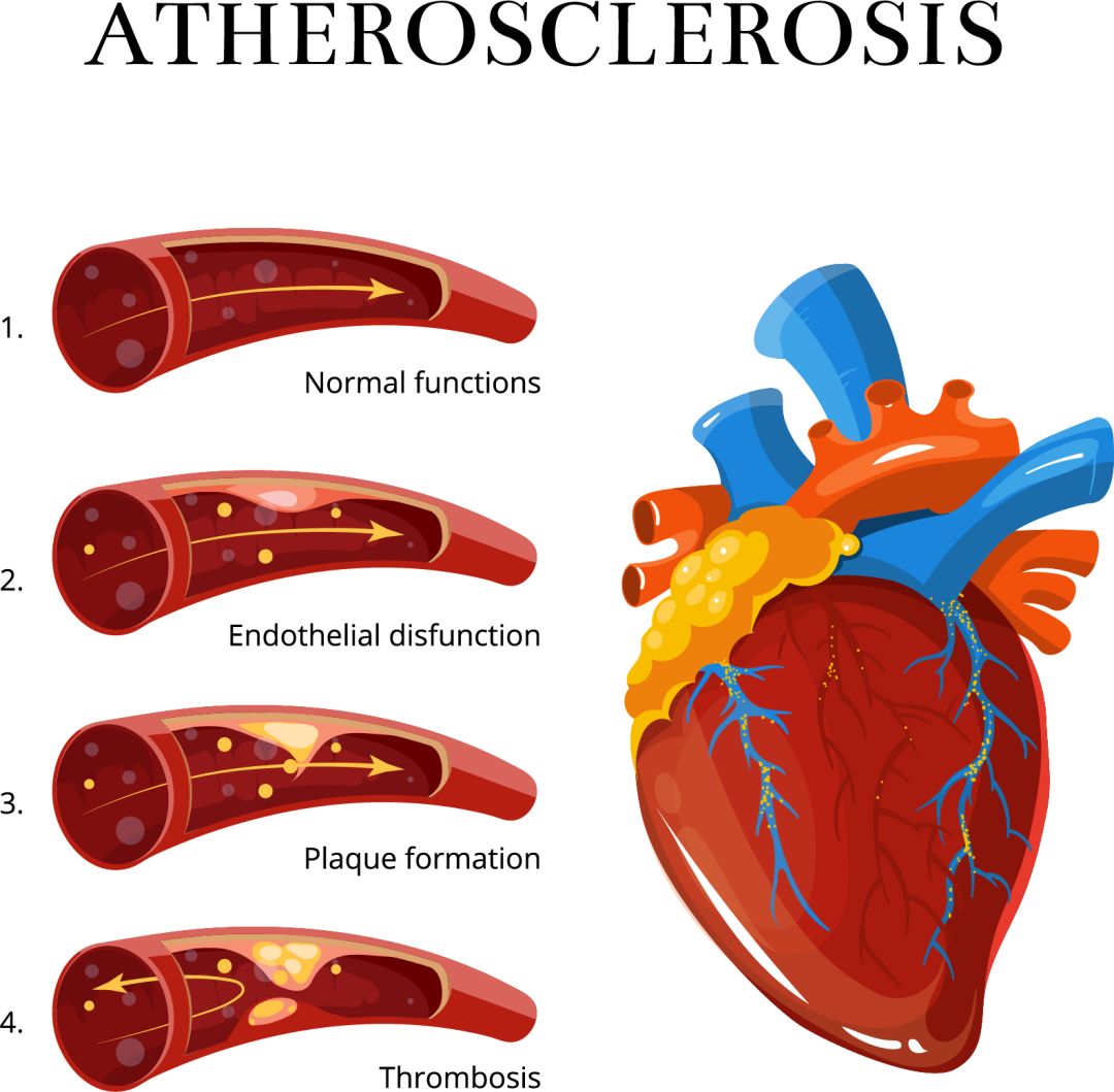 手绘-动脉粥样硬化-2