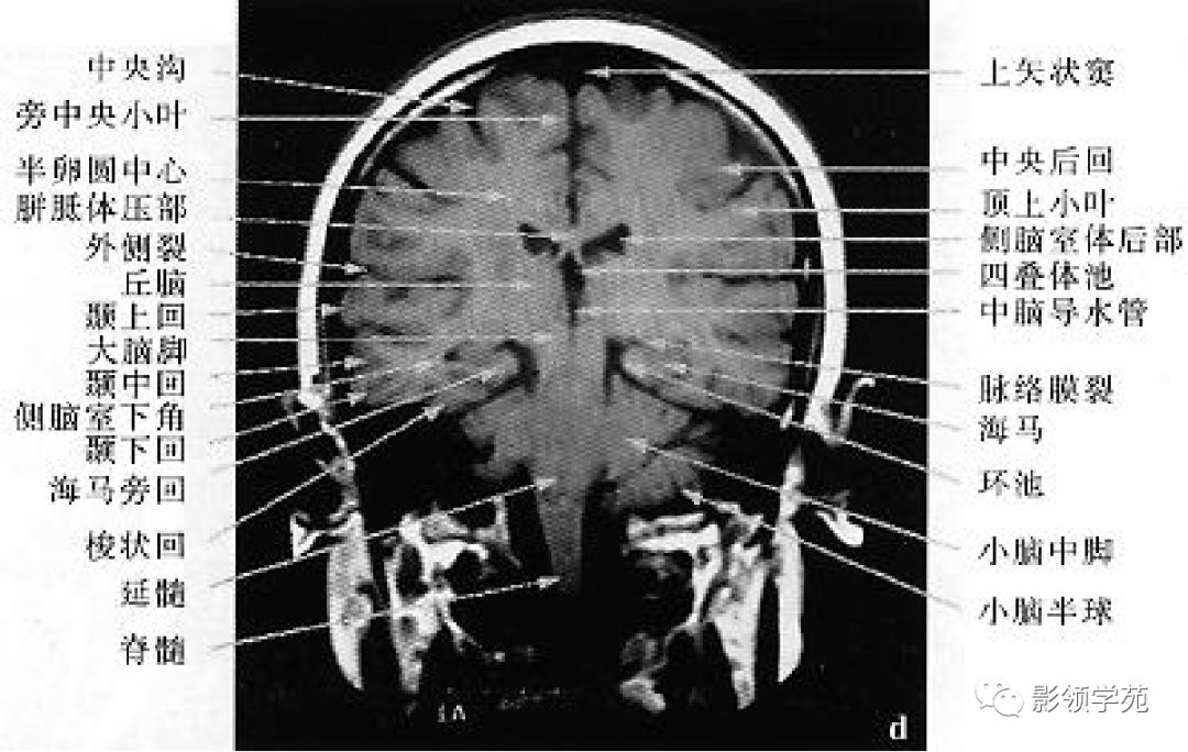 解剖&影像 | 头部解剖及ct影像