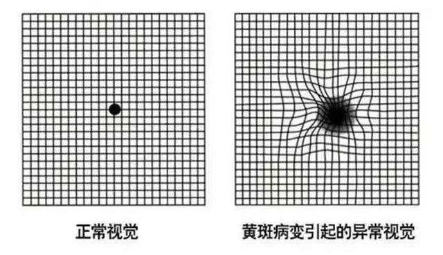 黄斑病变怎么办