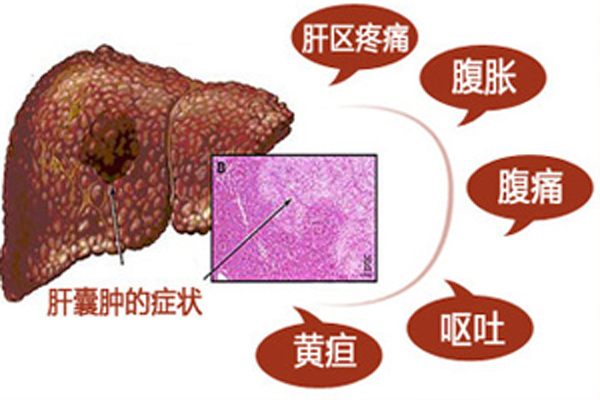 肝囊肿会自己消失吗不能关于肝囊肿医生有话对你说