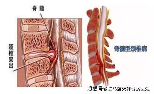 根据颈髓受损的部位,程度及临床表现,可将脊髓型颈椎病为中央型,椎体