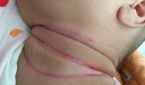 『爽身粉』孩子淹脖子怎么办？奶奶竟用爽身粉！这种错误别再犯了