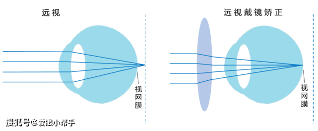 近视,远视,散光和老花怎么区分?