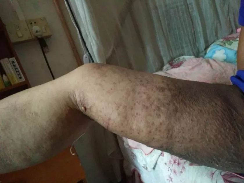 别称:象皮肿 英文名称:lymphedema of lower extremity 常见发病部位