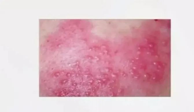 什么是单纯疱疹和带状疱疹 cc8f3f6207bf42aaa0ae8ac594b6fe97.jpeg