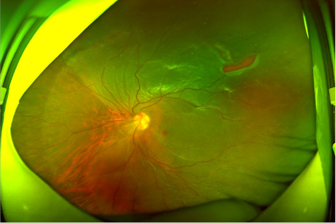 孔源性视网膜脱离