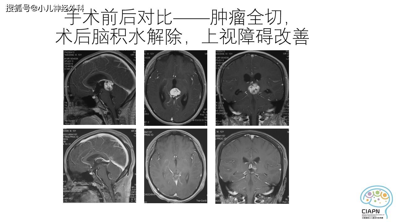 原创颅内肿瘤引起脑积水,是不是都要做分流手术