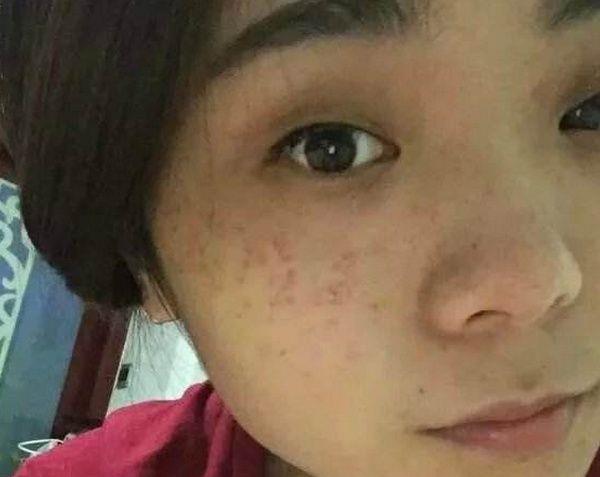 如何代谢斑点的黑色素 fcdd220553644a6bafa4beb2bb1a18a8.jpeg