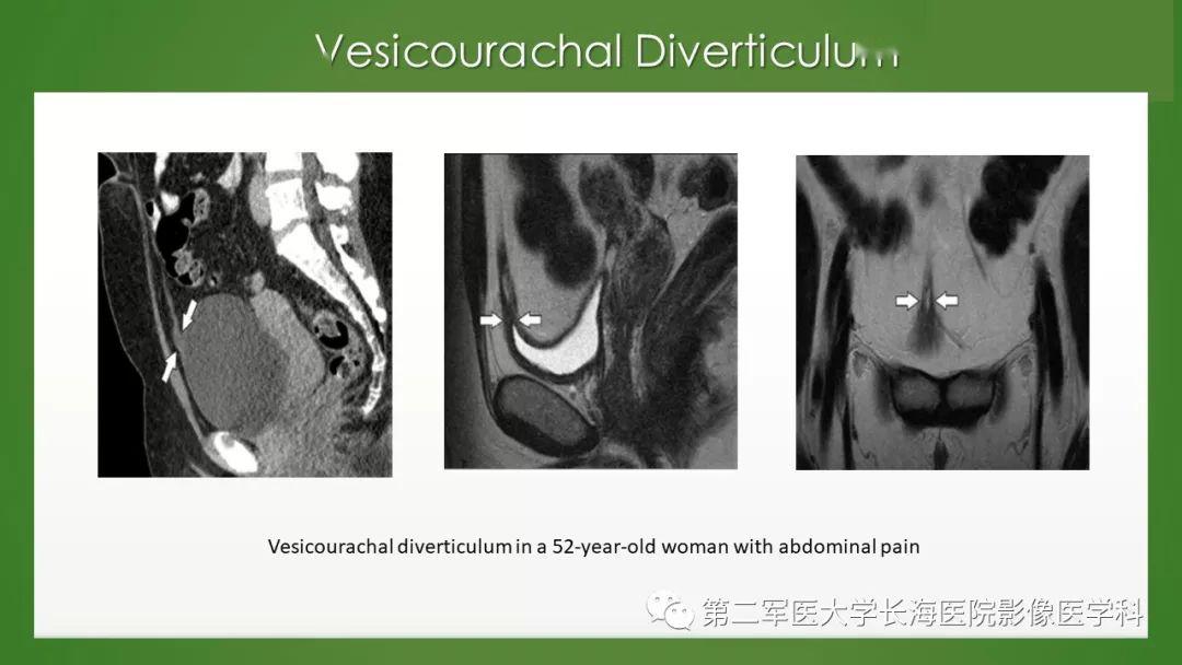 脐尿管异常的影像表现与临床
