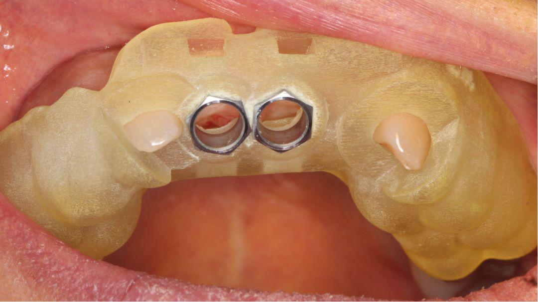 在implant guide手术导板引导下逐级扩孔,直至完成种植窝洞最终预备