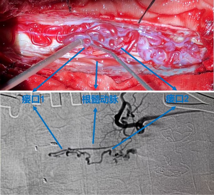 【正海-妙术视界】丨李东波教授:复合手术治疗髓周动静脉瘘1例