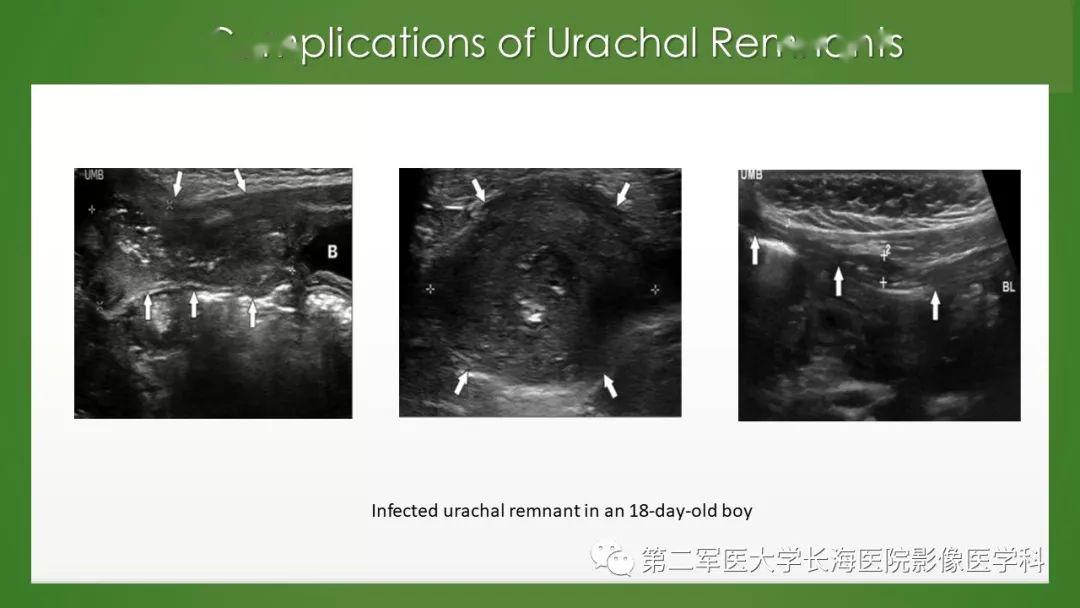 脐尿管异常的影像表现与临床