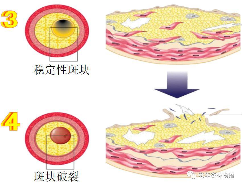 粥样硬化斑块有 "软"有 "硬" 硬斑块像皮厚馅小的饺子,不容易破