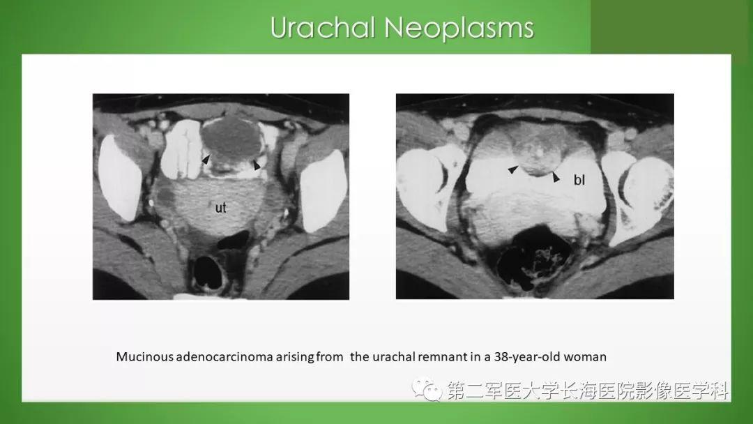脐尿管异常的影像表现与临床