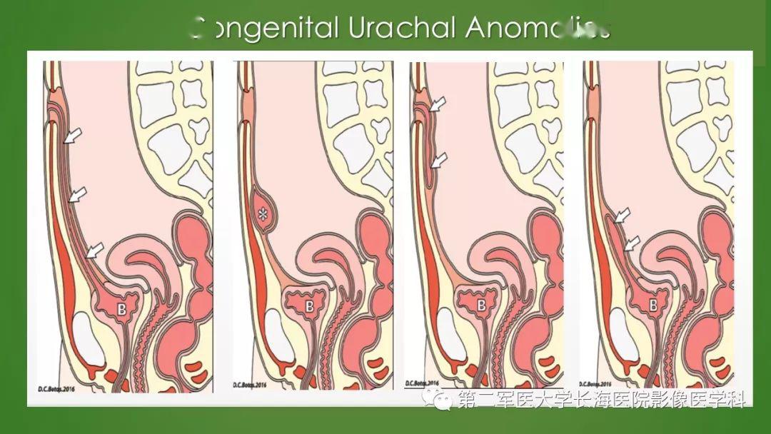 脐尿管异常的影像表现与临床