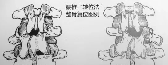腰椎小关节错位是什么？