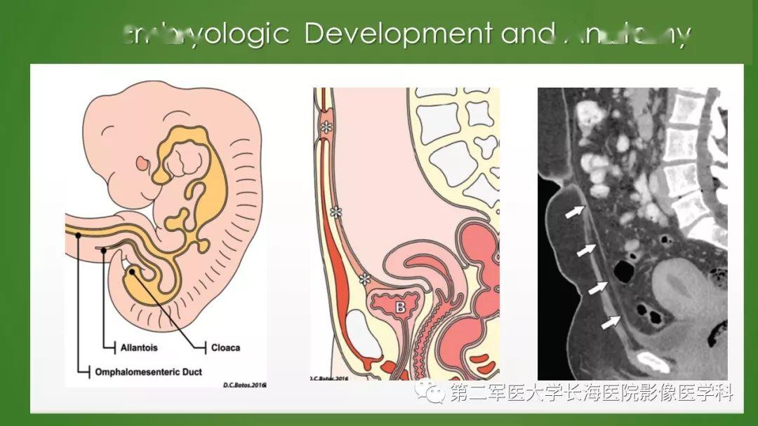 脐尿管异常的影像表现与临床