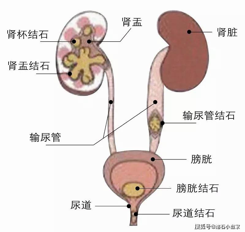 肾结石前期症状 aa05d14fbf5c46cd89867f86d69c8edd.jpeg