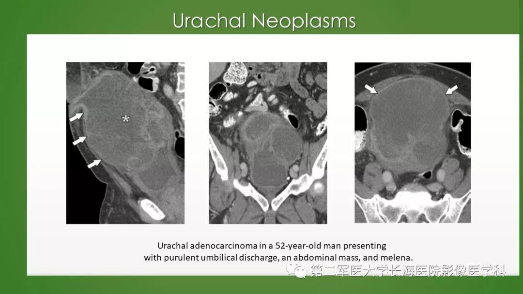 脐尿管异常的影像表现与临床