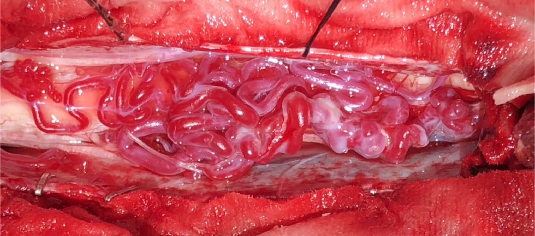 剪开蛛网膜见脊髓背侧异常血管团.寻找瘘口.