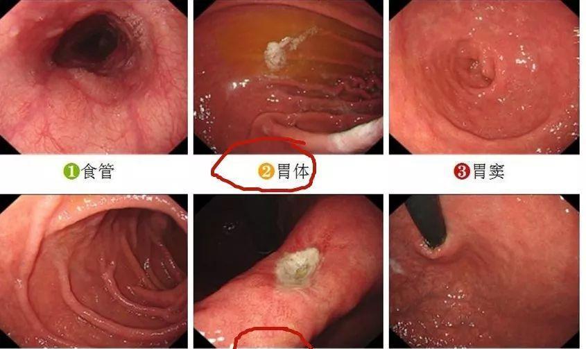 教你快速看懂胃镜报告!