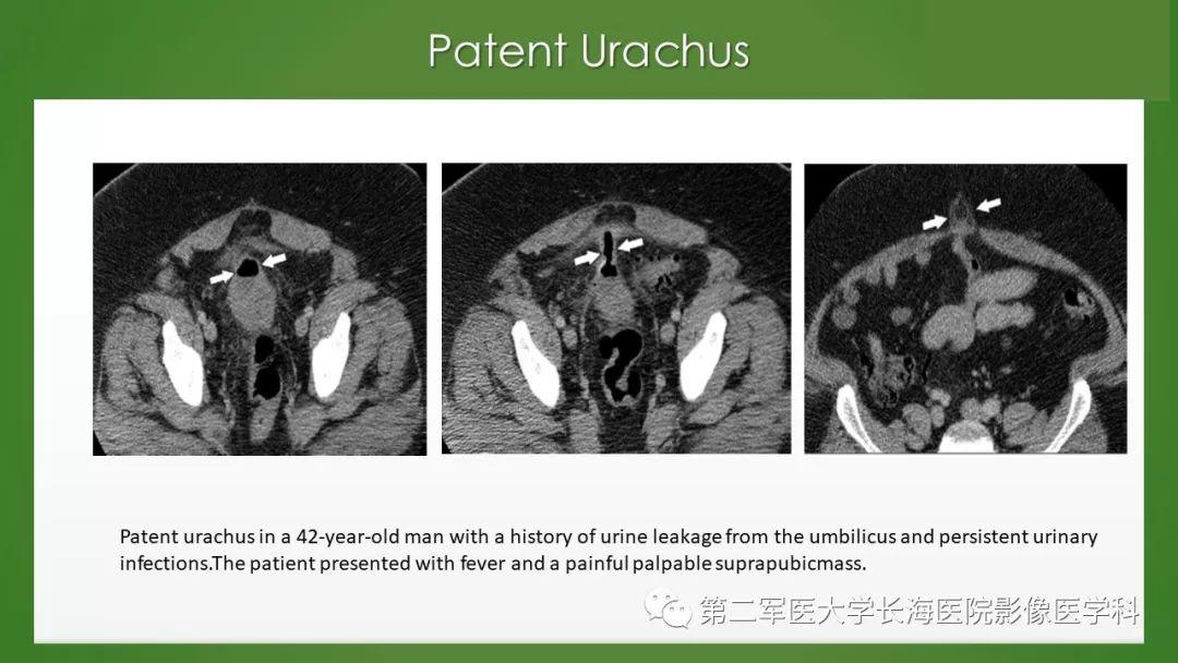脐尿管异常的影像表现与临床