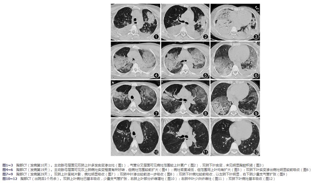 鹦鹉热衣原体致重症社区获得性肺炎一例